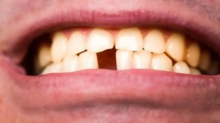 ¿Perder todos los dientes de arriba o todos los de abajo? - Sobremesa - DelSol 99.5 FM
