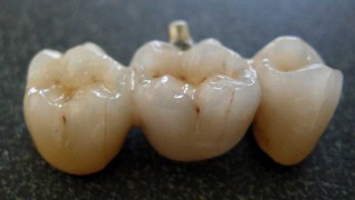 La porcelana dental, clave en la historia de las dentaduras postizas - Segmento dispositivo - DelSol 99.5 FM